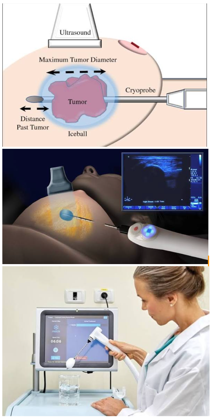 Cryoablation & Breast Cancer. FREEZING the tumour via MRI! The ...
